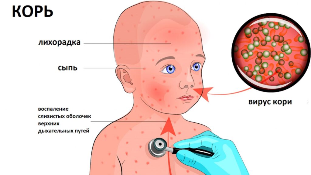 Количество болеющих корью увеличивается в Костанайской области