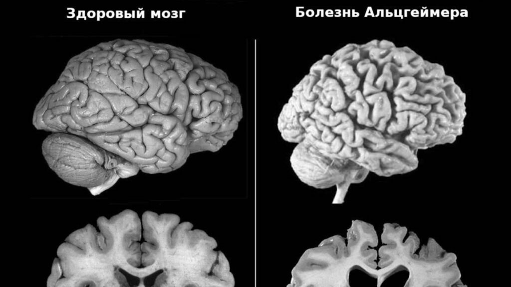 Ученые выясняли новый фактор риска болезни Альцгеймера