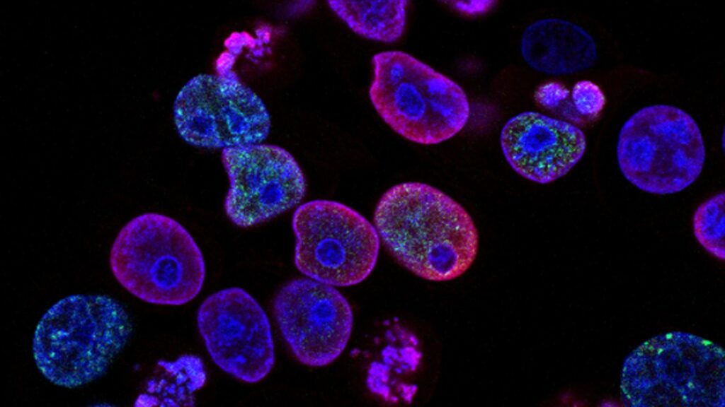 Раковые клетки под микроскопом
