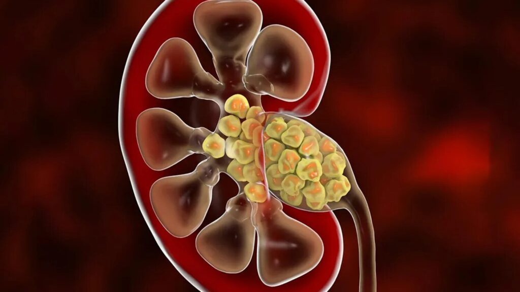 Ученые выявили связь между микробиомом и образованием почечных камней